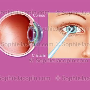 CHIRURGIE OCULAIRE LASER