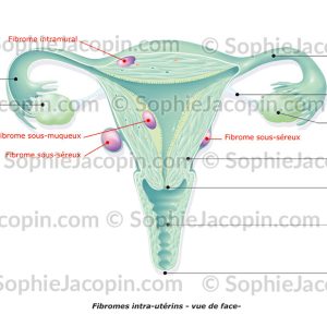 FIBROMES UTÉRINS