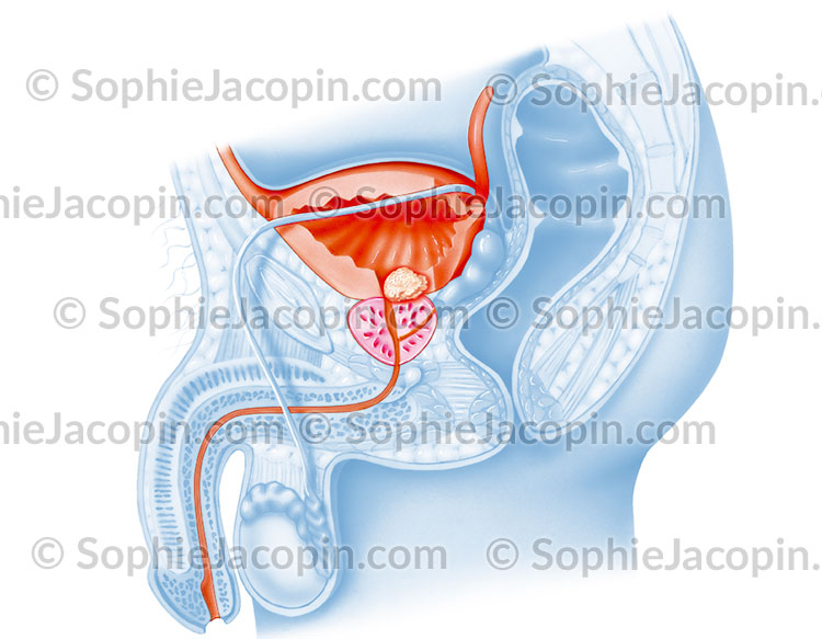 CANCER DE LA VESSIE – Image 2