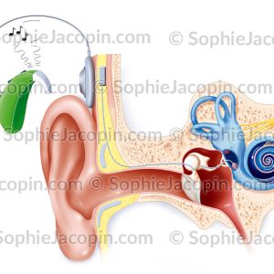 IMPLANT COCHLÉAIRE