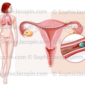 MST CHLAMYDIA