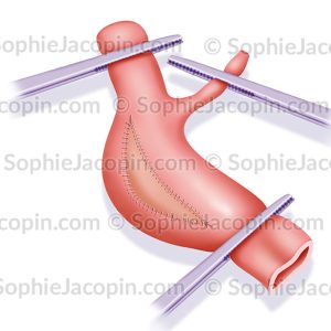 ENDARTERIECTOMIE