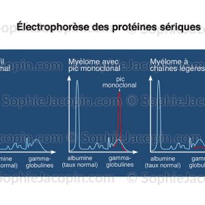 ÉLECTROPHORÈSE DES PROTÉINES SÉRIQUES