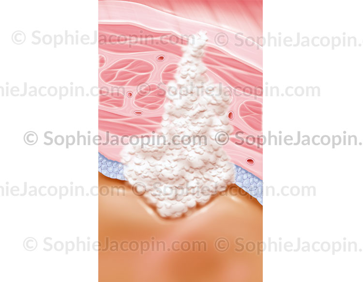 CANCER INVASIF DE LA VESSIE – Image 6